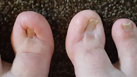 ugly feet pictures|really ugly toes.